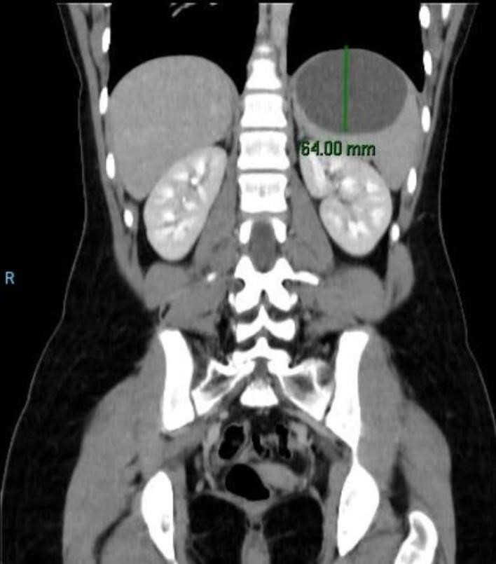 esplectomia-parcial-videolaparoscopica1