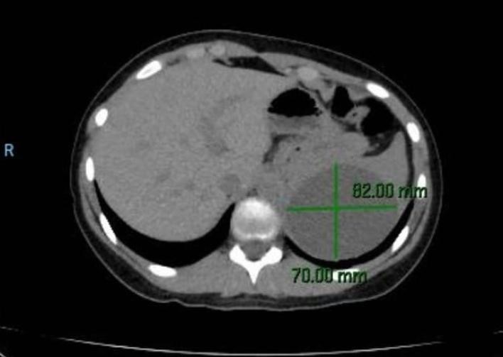 esplectomia-parcial-videolaparoscopica2