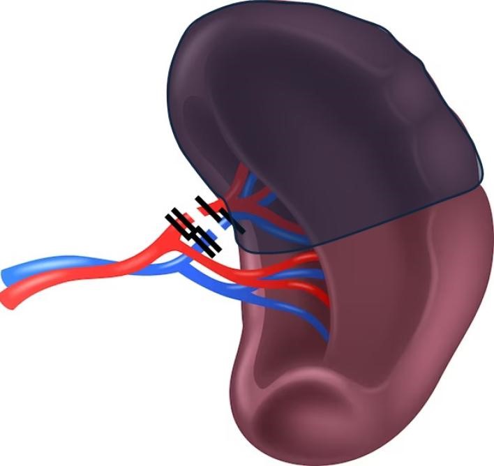 esplectomia-parcial-videolaparoscopica3