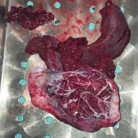 esplectomia-parcial-videolaparoscopica4