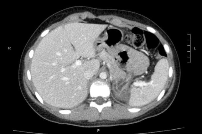 esplectomia-parcial-videolaparoscopica5