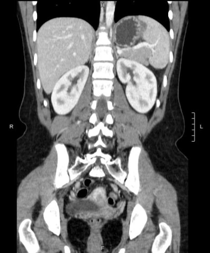 esplectomia-parcial-videolaparoscopica6