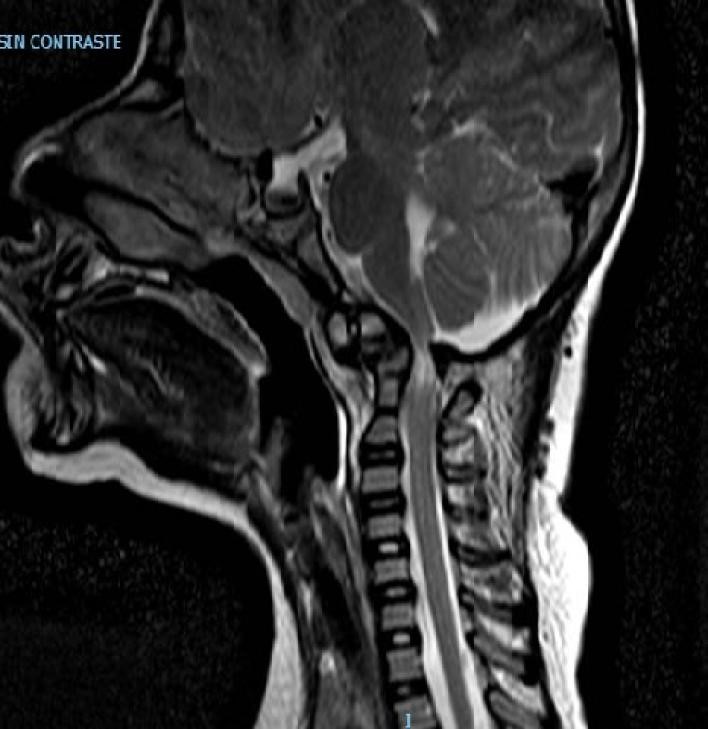 inestabilidad-craneo-cervical2