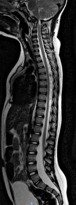 inestabilidad-craneo-cervical3