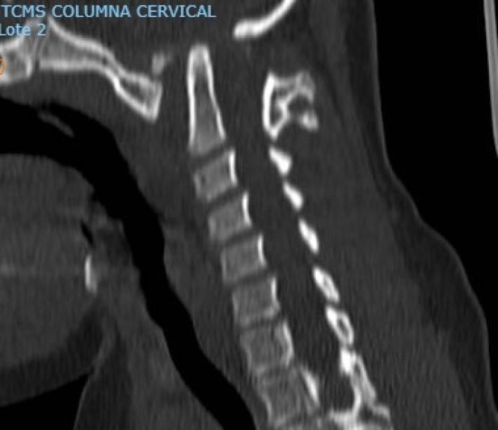 inestabilidad-craneo-cervical4