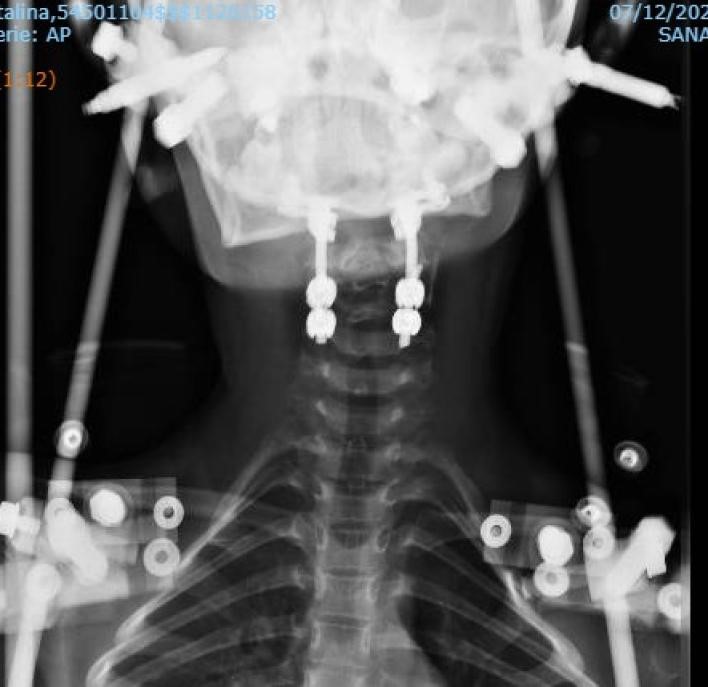 inestabilidad-craneo-cervical5