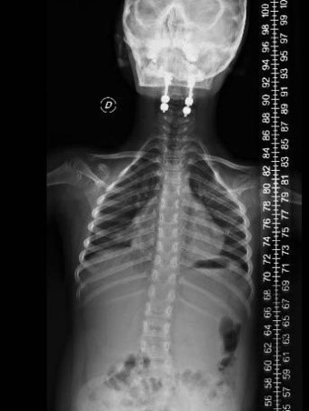 inestabilidad-craneo-cervical7